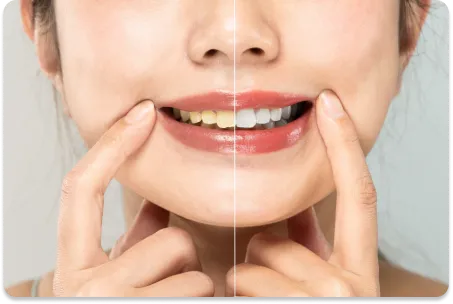 Before and after smile transformation